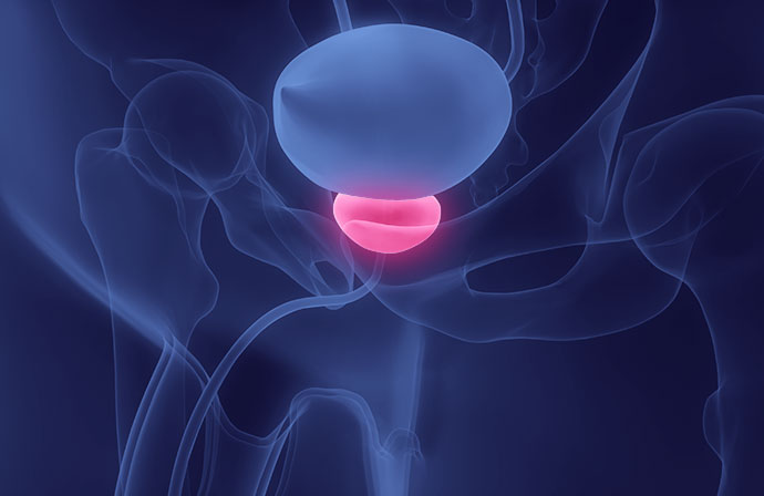 Prostate Artery Embolisation PAE Treatment At The Urology Partnership