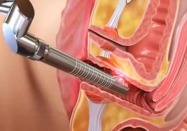 thumbnail interactive-video image 1 of Zeus Laser Therapy Vaginitis Tightening & Rejuvenation Cold Laser – 650nm, Complete Set 1 of 4