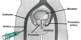 Prostate Artery Embolisation