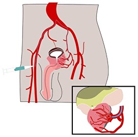 prostate artery embolisation