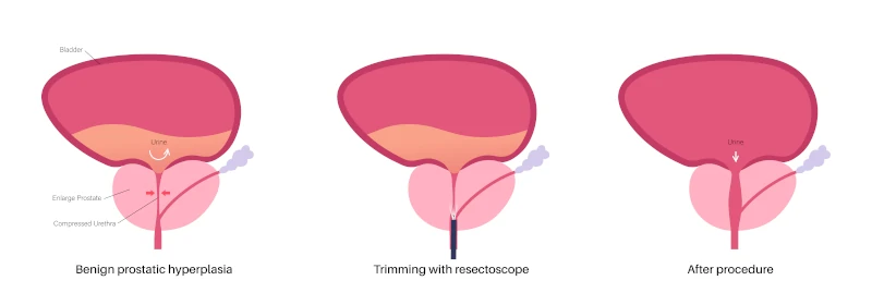 illustration of enlarged prostate before and after TURP surgery