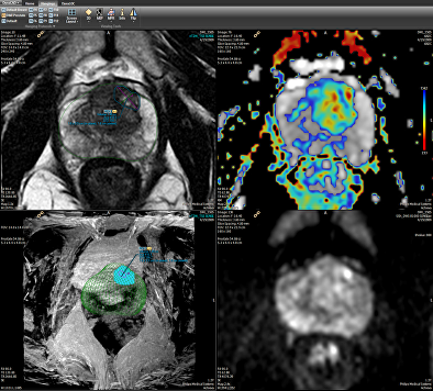 multi-parametric MRI scan of the prostate