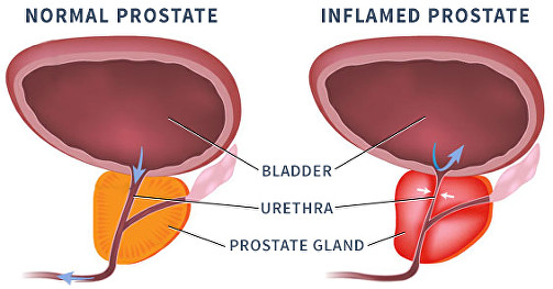 normal vs inflammed prostate