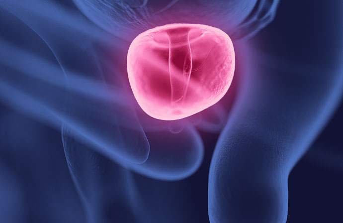 Rezum лечение аденомы. Rezum лечение аденомы. Энуклеация аденомы простаты. Простата иллюстрация. Rezum лечение аденомы.