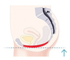 illustration of strengthened female pelvic floor after Emsella treatment