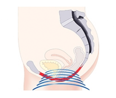 Illustration of a woman's pelvic floor having BTL Emsella treatment