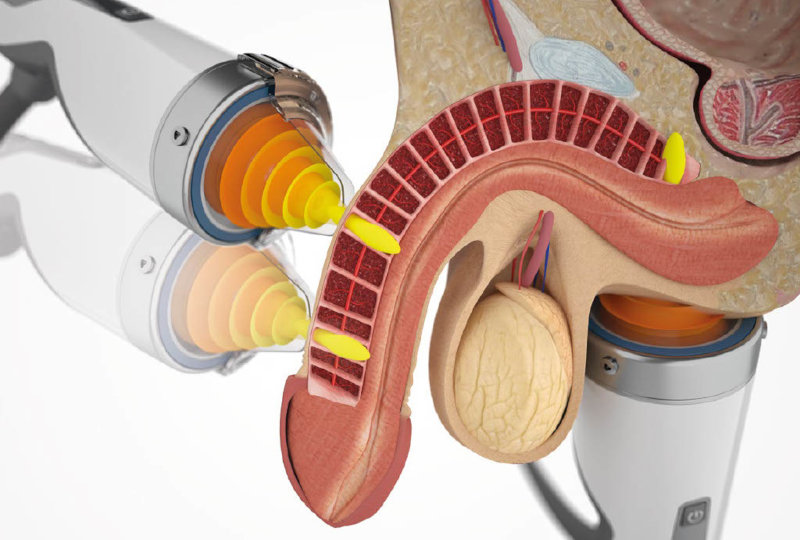 Low-intensity focused shockwaves treating erectile dysfunction